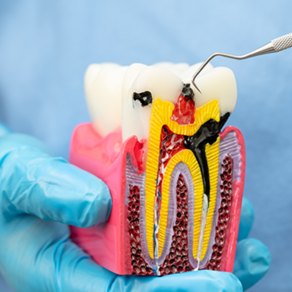Tooth Preparation